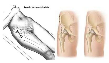 Τεχνική AMIS (Anterior Minimally Invasive Surgery) Image